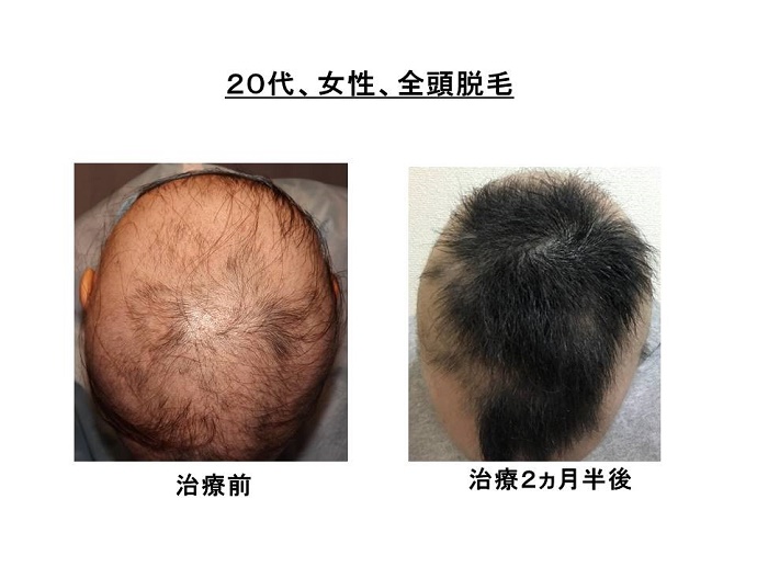 円形脱毛症　病院""